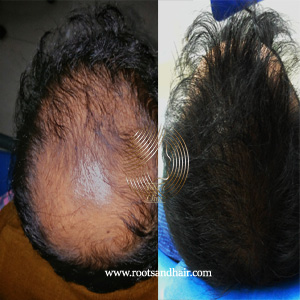 Best Hair Transplant Surgeon in Jaipur I Leading Hair Clinic I Affordable  FUE Hair Transplant in Jaipur