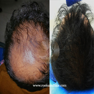 Best Hair Transplant Surgeon in Jaipur I Leading Hair Clinic I Affordable FUE Hair Transplant in Jaipur Best Hair Transplant Surgeon in Jaipur I Leading Hair Clinic I Affordable FUE Hair Transplant in Jaipur