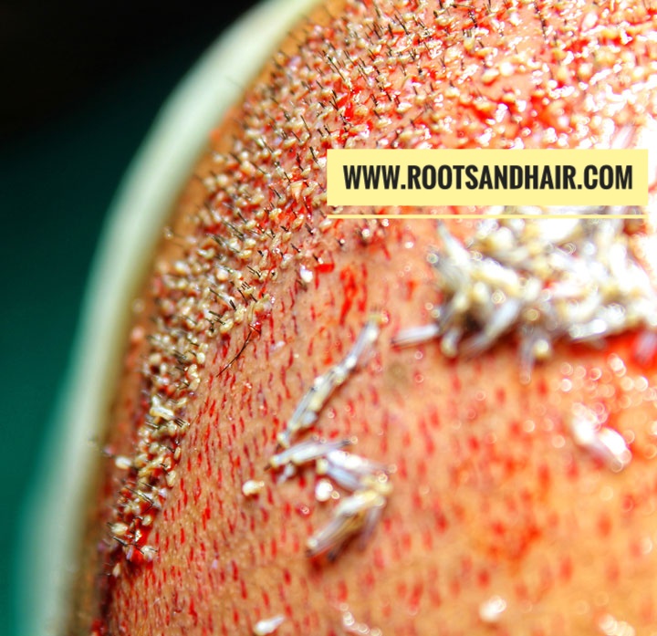 Roots & Hair-Best Hair Transplant Centre in Jaipur Roots & Hair-Best Hair Transplant Centre in Jaipur