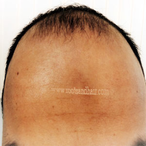 Best Hair Transplant Surgeon in Jaipur I Leading Hair Clinic I Affordable FUE Hair Transplant in Jaipur Best Hair Transplant Surgeon in Jaipur I Leading Hair Clinic I Affordable FUE Hair Transplant in Jaipur