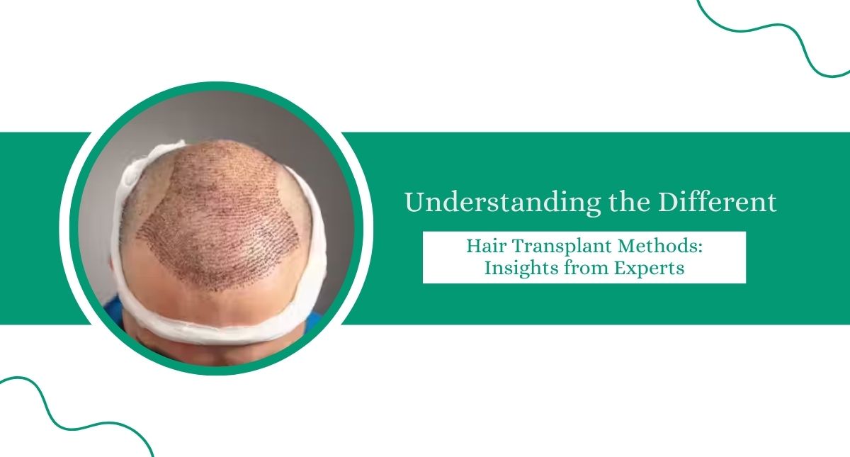 Understanding the Different Hair Transplant Methods: Insights from Experts